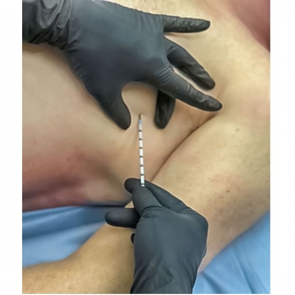 Декомпресійна голка ARS Needle Kit